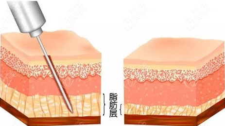 吸脂手術(shù)