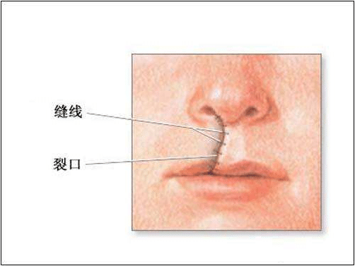 兔唇修復(fù) 兔唇修復(fù)