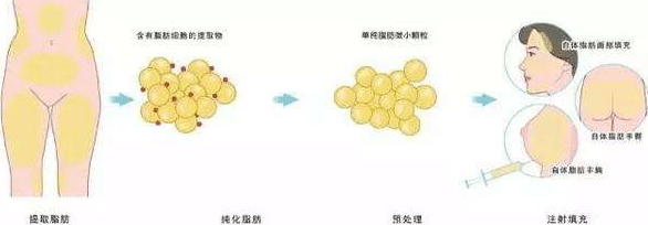 抽脂隆胸能堅持幾年?能不能多注射脂肪?