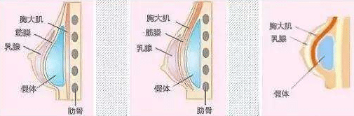 隆胸會影響哺乳嗎？硅膠隆胸有哪些后遺癥？