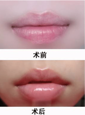 自體脂肪豐唇