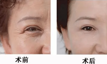 生物注射除皺