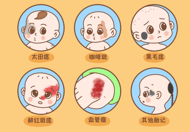 胎記分類