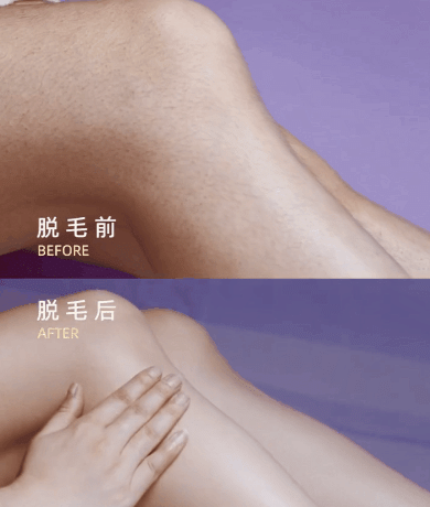 脫毛手術(shù)前后對比