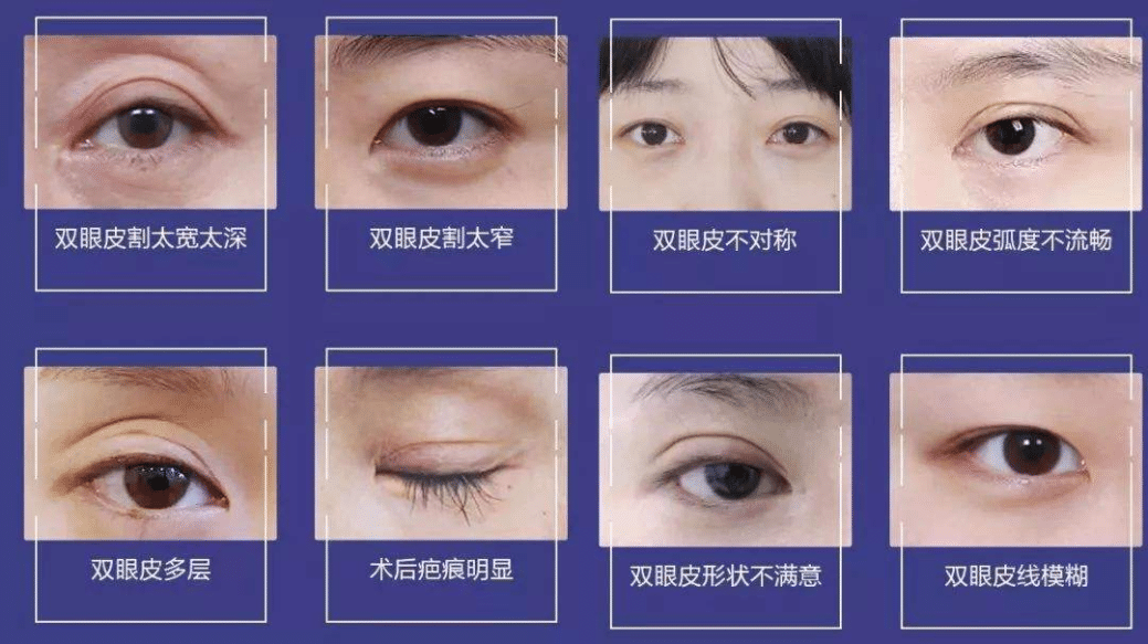 雙眼皮修復(fù)需要多少錢?雙眼皮失敗修復(fù)后的注意事項(xiàng)?