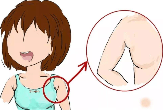 吸脂去副乳前后對比