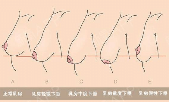 胸部下垂解析圖