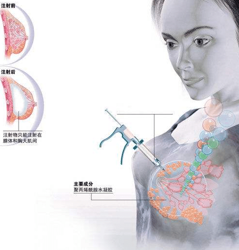 玻尿酸豐胸