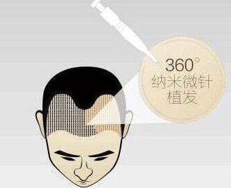 植發(fā)手術(shù)