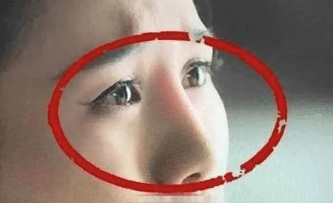 隆鼻假體透光
