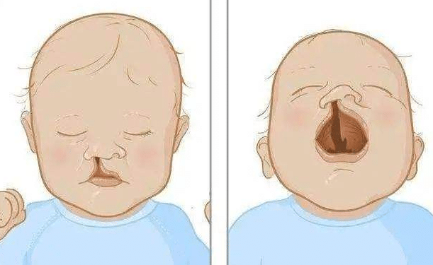 唇腭裂