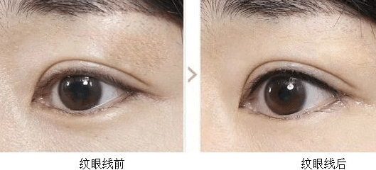 紋眼線前后對(duì)比