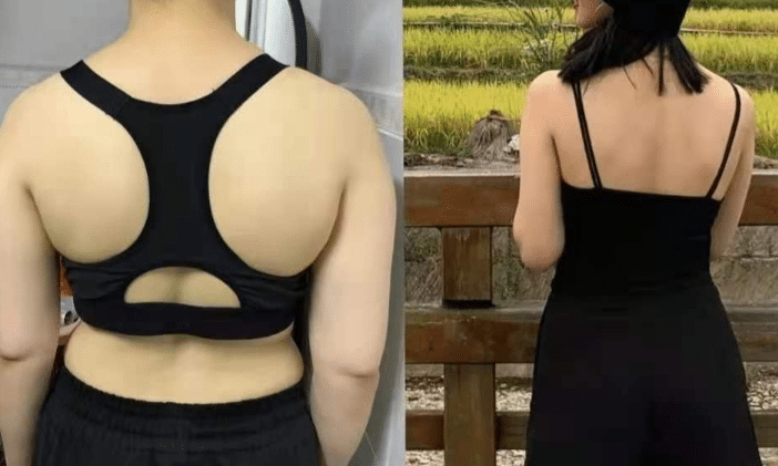 肩部吸脂前后對比