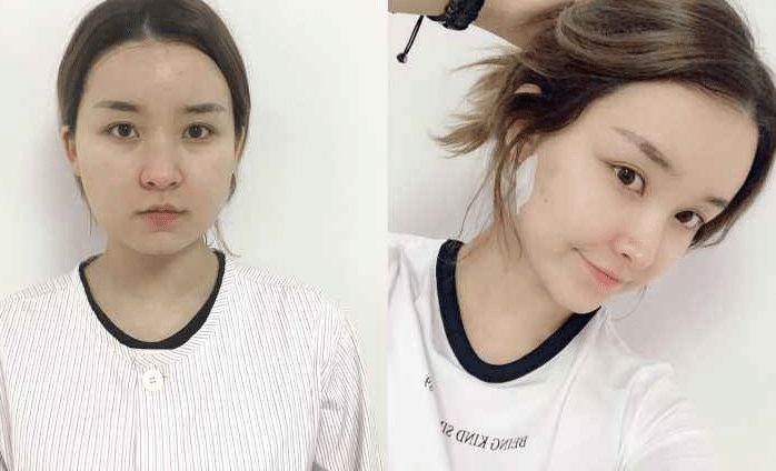 面部吸脂前后對比