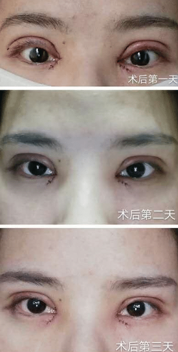 眼綜合術(shù)后護(hù)理