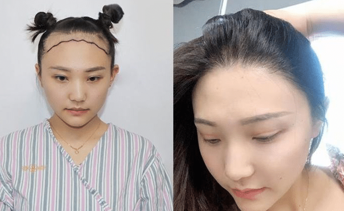 植發(fā)前后對比