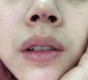 線雕鼻失敗
