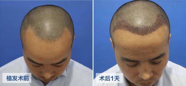 移植3000個毛囊要多少錢?植發(fā)后多久可以恢復?