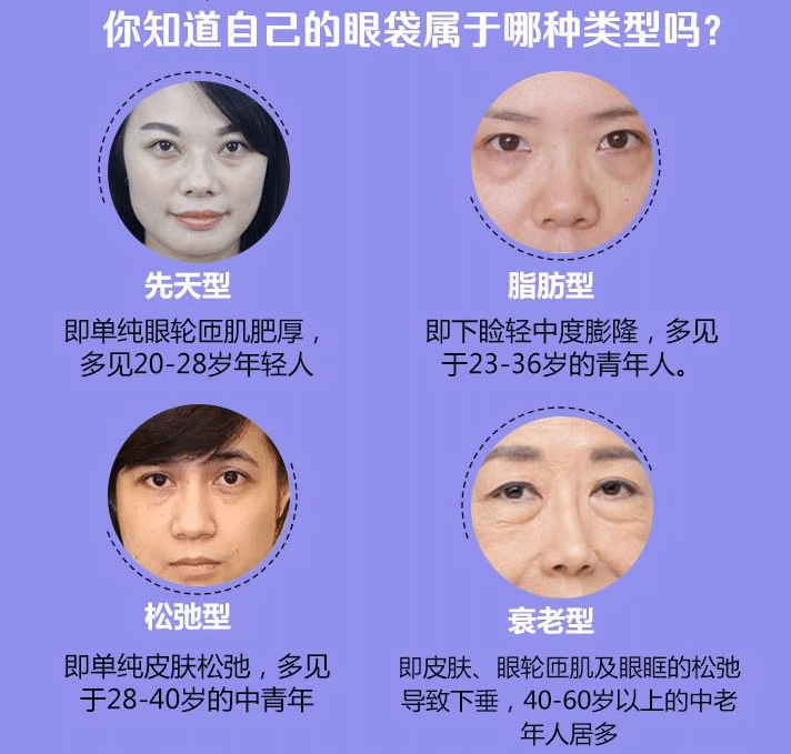 眼袋手術會反彈嗎？導致反彈的原因是什么？