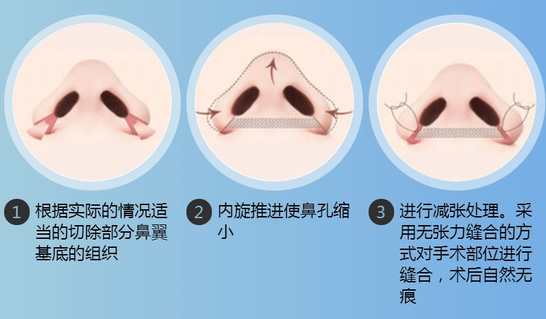 鼻翼縮小術(shù)留疤幾率大嗎?鼻孔整形效內(nèi)切和外切哪個(gè)好?