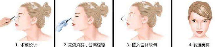 耳軟骨隆鼻