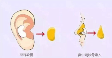 耳軟骨