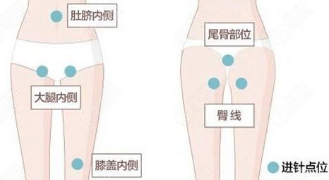 大腿吸脂過程
