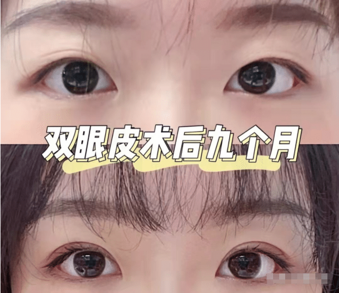 雙眼皮哪個(gè)好?哪種雙眼皮手術(shù)方法適合我?
