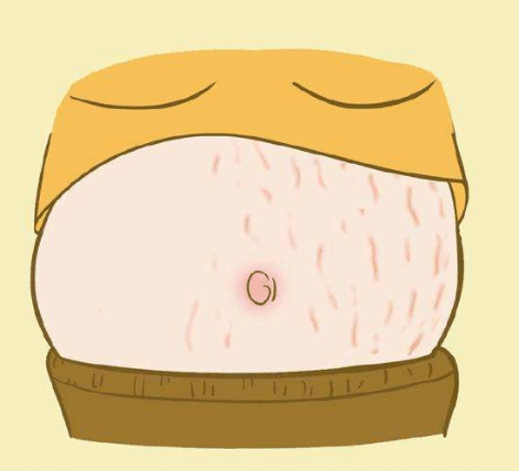 妊娠紋