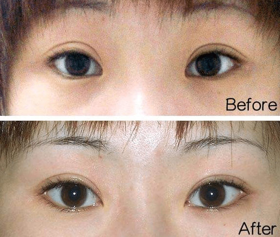 開眼角前后對比