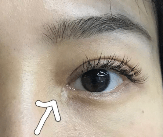 開眼角后的疤痕增生