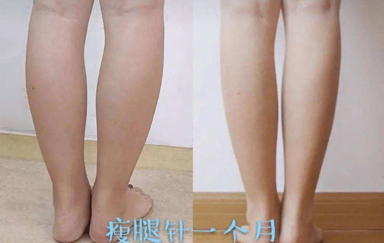 瘦腿針前后對(duì)比