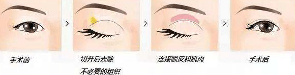 重瞼術(shù)