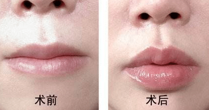 玻尿酸豐唇前后對比
