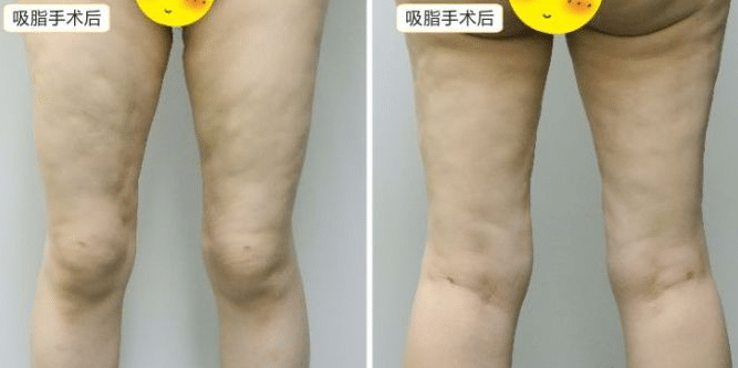 吸脂失敗
