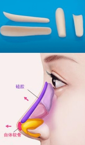 隆鼻 隆鼻