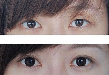 埋線雙眼皮前后對(duì)比