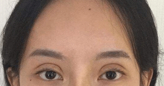 雙眼皮失敗