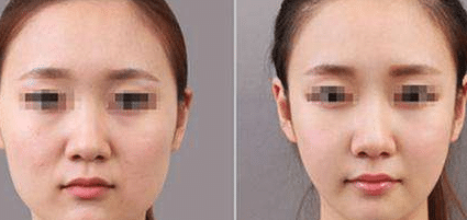 溶脂針前后對比