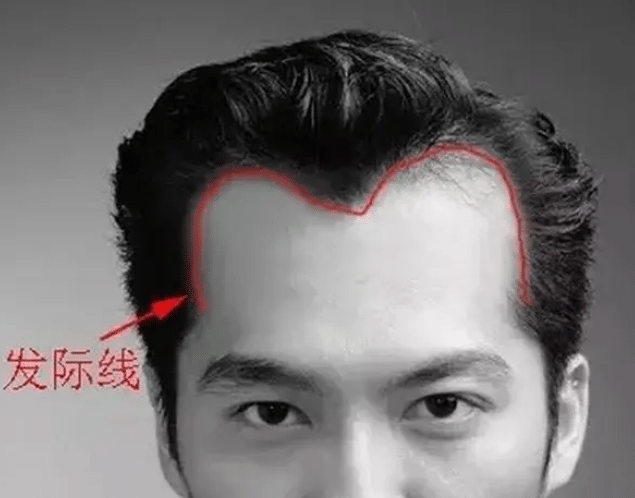 高發(fā)際線