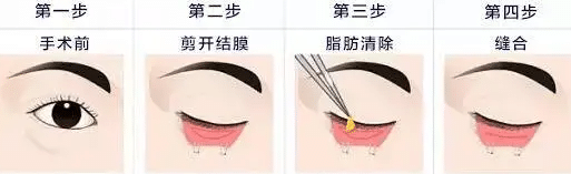 內(nèi)切法祛眼袋