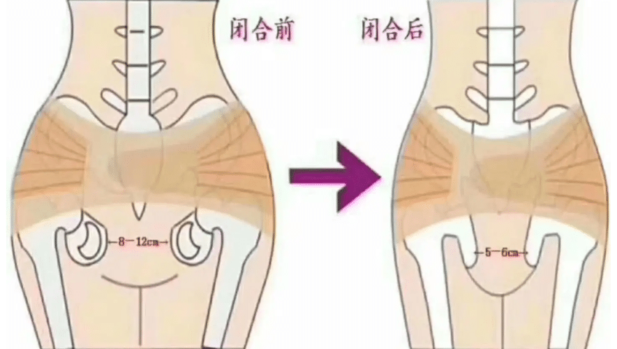 盆骨修復(fù)前后對(duì)比