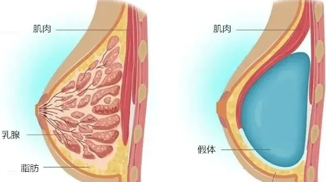 假體隆胸
