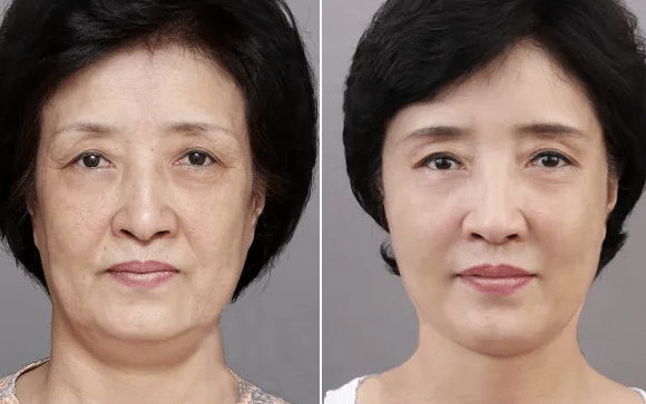 熱瑪吉前后對(duì)比 熱瑪吉前后對(duì)比