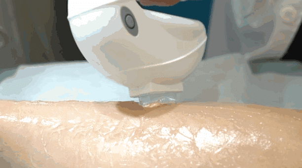 激光脫毛