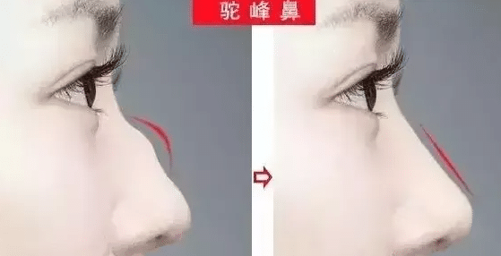駝峰鼻前后對比