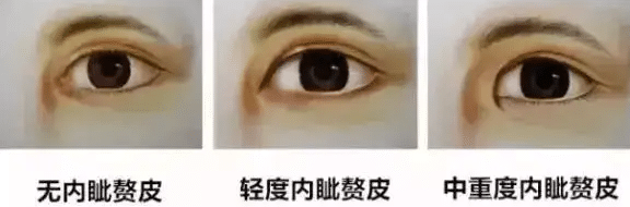 內(nèi)眥贅皮