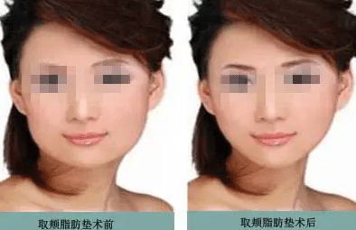 去頰脂墊瘦臉前后對(duì)比