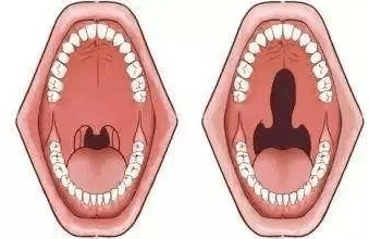 腭隱裂