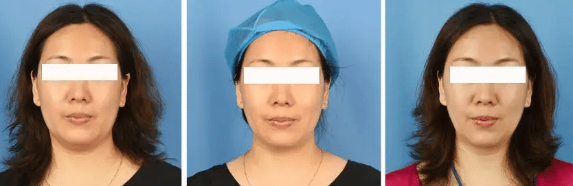 超聲炮前后對比